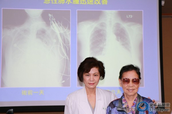 导管瓣膜植入术救心衰竭 87岁嬷「开心」3天便