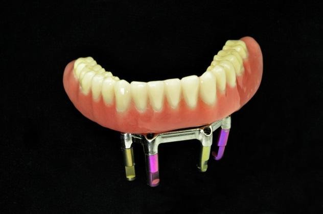 牙周病+假牙清除難女剩18顆牙!(圖/超植牙醫診所提供)