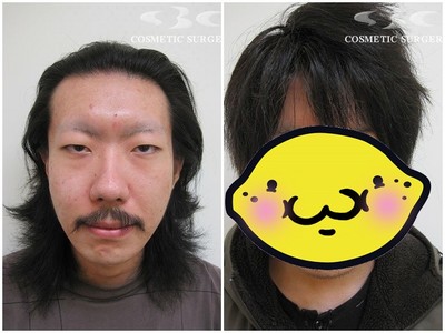 日本男整形割雙眼皮，割完後「變態感」UP↑