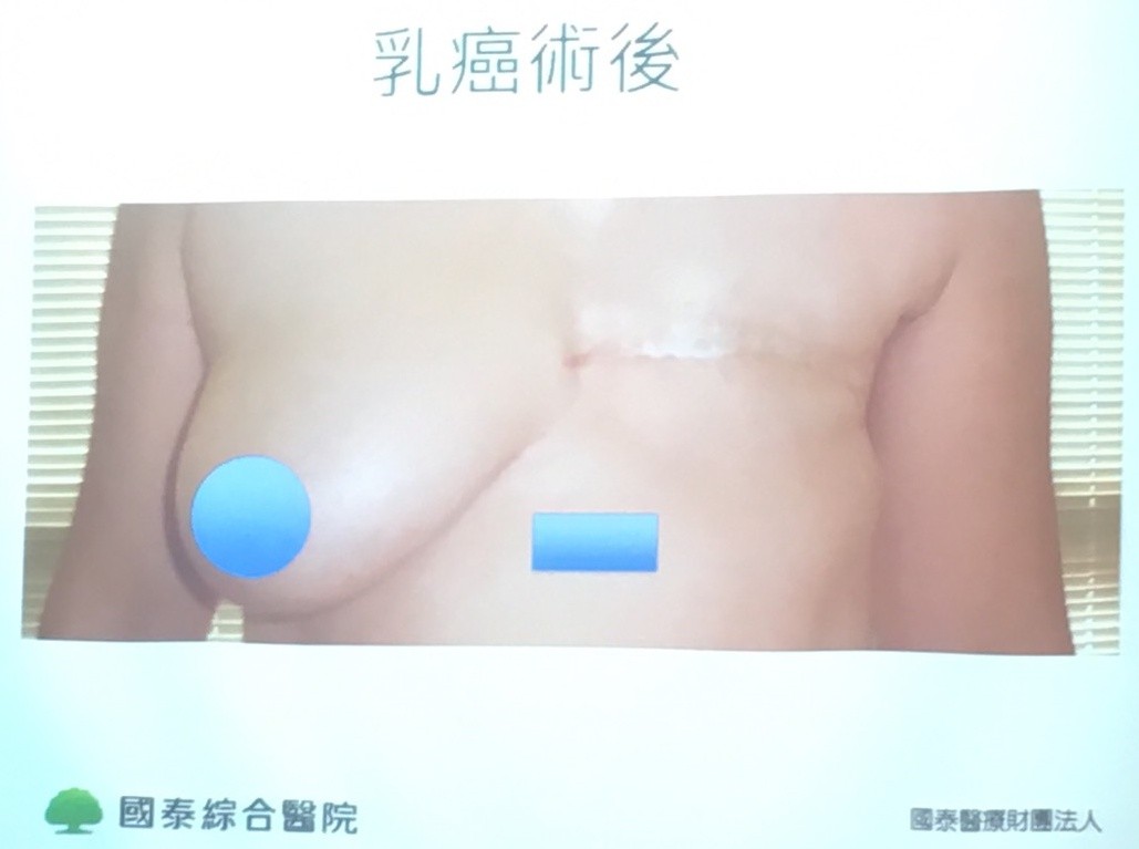 乳癌。(圖/記者嚴云岑攝)