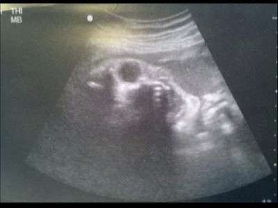 孕媽咪拍胎兒超音波，卻看到照片中有"東西"盯著她..