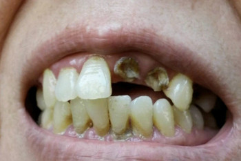 蛀牙小心齒源性蜂窩性組織炎。（圖／台北慈濟醫院提供）