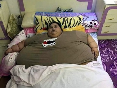 被寄生蟲變成「世界最胖女」：超過500公斤、25年下不了床