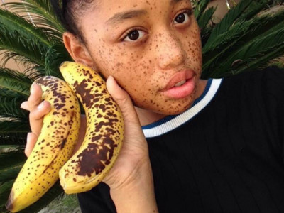 18歲美菲混血「香蕉斑」女孩，不畏嘲笑終踏上名模伸展台