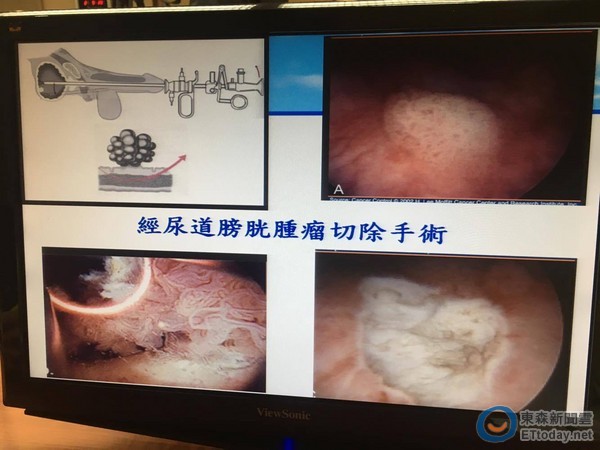 膀胱癌基因突变暴冲 长庚靠「油门阻力」原理找到解药