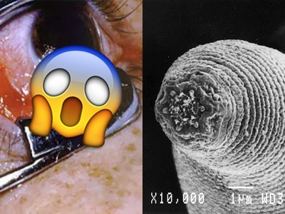 噁爆！這些寄生蟲猛鑽人體孔洞　最愛食物是「你的大腦」