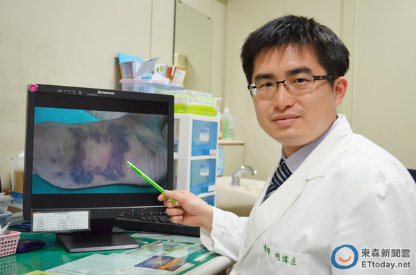 男脚底「乌青」越长越大片 竟罹患「典型卡波西氏肉瘤」