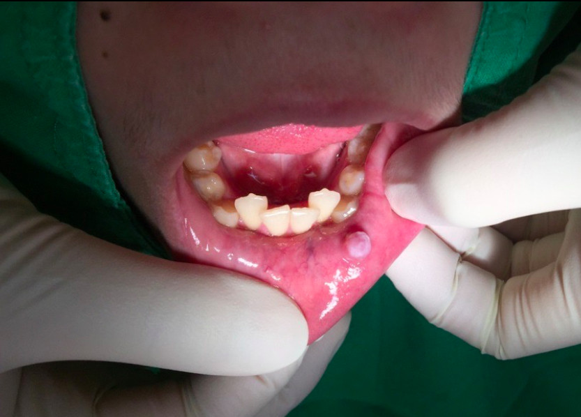 黏液囊腫。(圖/北市聯醫提供) 黏液囊腫。(圖/北市聯醫提供)