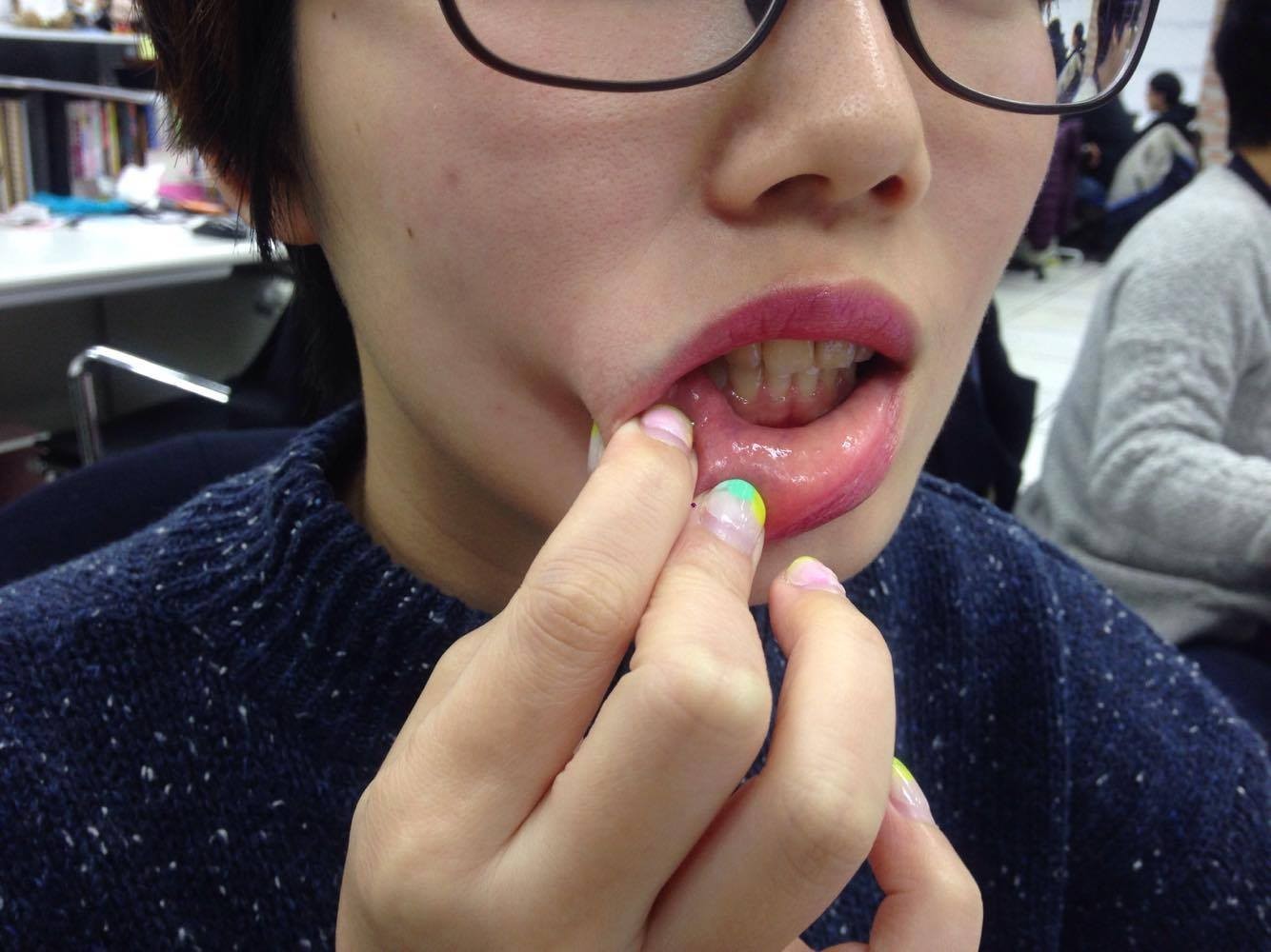 嘴破。(圖/記者李佳蓉攝)