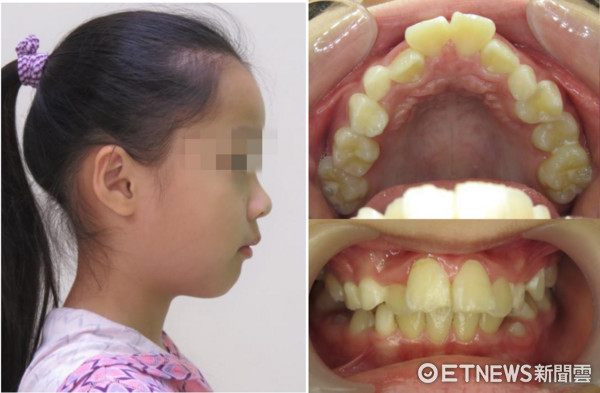 ▲鼻塞影響齒顎發育9歲女童側臉「幾乎沒下巴」。（圖／記者嚴云岑攝）