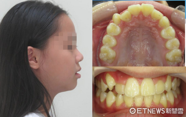 ▲鼻塞影響齒顎發育9歲女童側臉「幾乎沒下巴」。（圖／三軍總醫院提供）