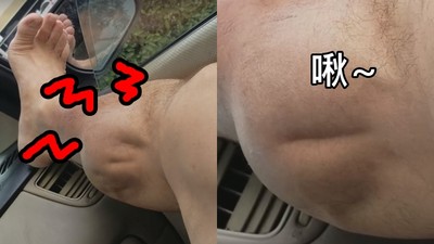 停不了的抽筋「小腿蠕動狂跳」　鐵腿男哭吼：痛到XX娘！