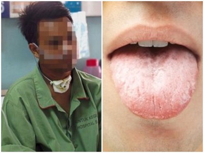 17歲抽菸「24歲患口腔癌」　切掉大塊舌頭保命