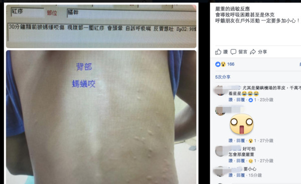 ▲被螞蟻咬過敏。(圖/取自急診醫師的眼睛(白永嘉醫師)臉書)