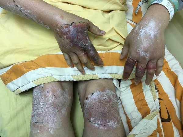 ▲塗「黑面馬」治酸痛 手真的發黑了。(圖/取自林靜儀臉書)