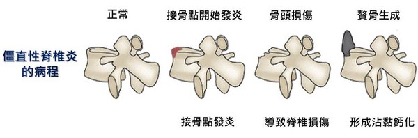 僵直性脊椎炎。（圖／台北慈濟醫院提供）