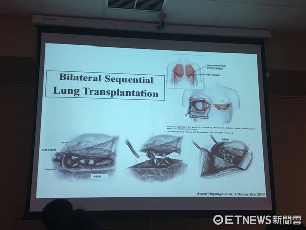 ▲邊緣性肺臟移植。(圖/記者嚴云岑攝)