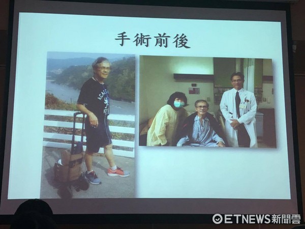 ▲邊緣性肺臟移植。(圖/記者嚴云岑攝)