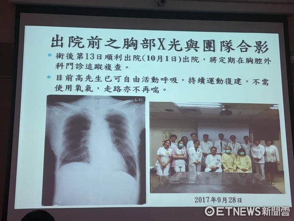 ▲邊緣性肺臟移植。(圖/記者嚴云岑攝)