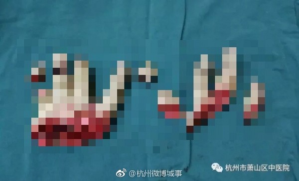 ▲工廠老闆清洗風機,9根手指被砍斷。(圖/翻攝自杭州微博城事)