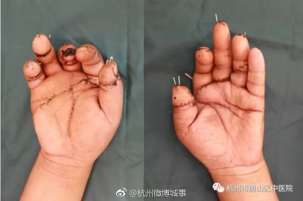 ▲工廠老闆清洗風機,9根手指被砍斷。(圖/翻攝自杭州微博城事)