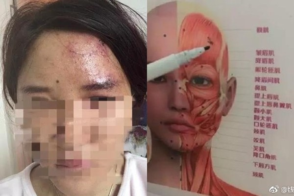 ▲▼互打玻尿酸 1針扎下去...閨蜜喊痛。(圖/翻攝自錢江晚報微博)