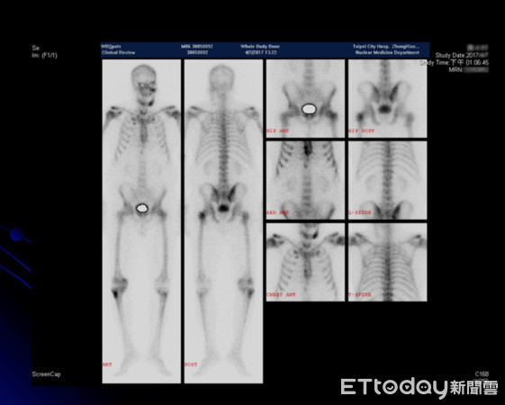▲下巴麻木「冷熱分不出」 竟是癌轉移「只能再活15月」。(圖/書田診所提供)