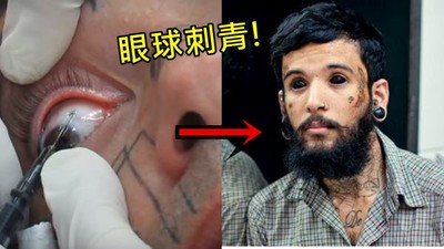 噁！針頭插眼刺出「全黑目珠」　潮男術後秒失神…無法翻白眼了