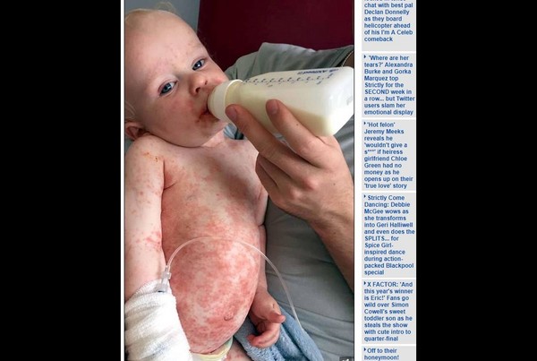 ▲▼ 北愛爾蘭16個月大男嬰被患有唇皰疹的人親了之後，全身起紅疹水泡，醫生還三度說沒事，差點斷送男嬰性命。（圖／翻攝自《每日郵報》）