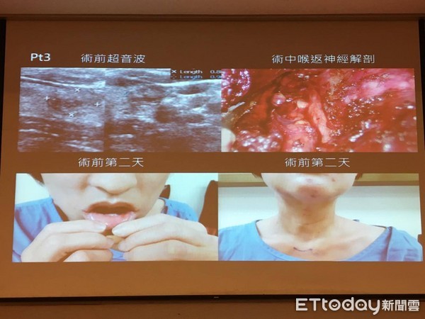 ▲甲狀腺手術像「割喉」 新技術「下唇戳3洞」就能拉出來。(圖/記者嚴云岑攝)
