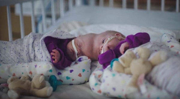 ▲▼ 顱部聯胎（craniopagus）女寶寶艾琳和艾比（Erin and Abby Delaney）接受分離手術，於20日出院返家。（圖／翻攝自Youtube）