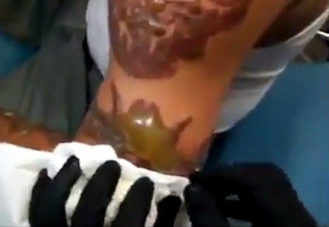 ▲男子刺青的手臂上佈滿了水泡。（圖／翻攝自Dr Medical Cases臉書）