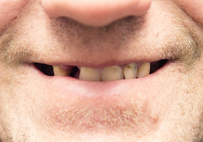不刷牙會得阿茲海默症！　新研究發現「牙周細菌侵腦」造成退化