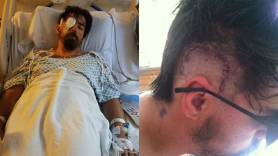 右眼後方像被撞擊！29歲男無預警中風　腦斷層：顱腔全被血填滿