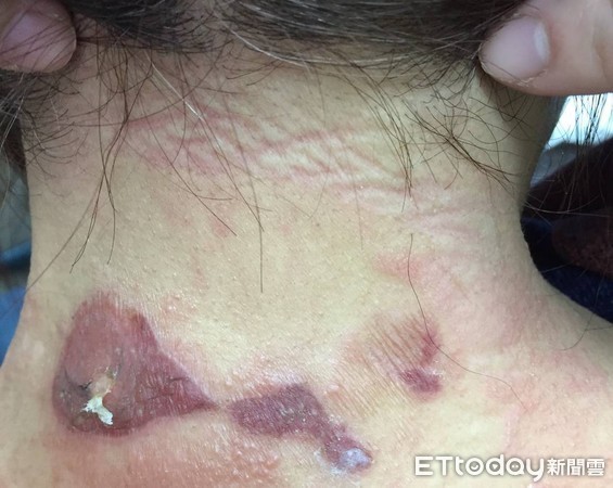 ▲暖暖包敷脖子「舒服到睡著」 她半夜痛醒頸部二度灼傷。(圖/趙昭明醫師提供)