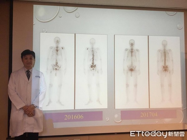 ▲全身酸痛確診「末期肺腺癌」 服藥2年腫瘤指數趨近於0。(圖/記者嚴云岑攝)