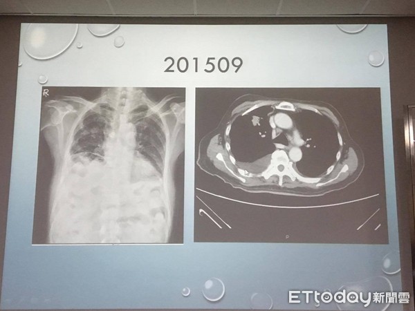 ▲全身酸痛確診「末期肺腺癌」 服藥2年腫瘤指數趨近於0。(圖/記者嚴云岑攝)