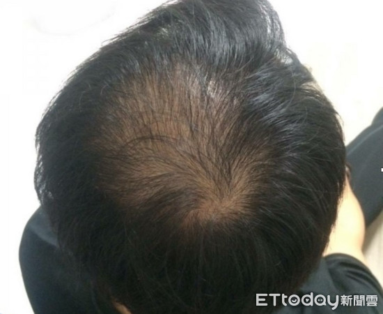 头发狂掉怕早秃? 3方法在家测:有原子笔跟尺就