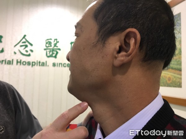 ▲「看得出我罹癌嗎?」鼻咽癌轉移腫瘤消失 僅脖子黑一半。(圖/記者嚴云岑攝)