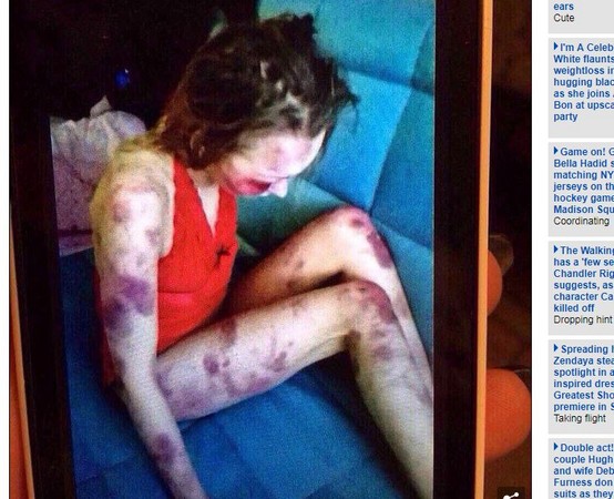 ▲▼ 俄國34歲男子格列巴諾夫(Maxim Gribanov)暴打28歲妻子奧維安尼科娃(Anastasia Ovsiannikova),導致她的臉部、四肢遍布瘀青,甚至還把家暴她的照片傳給朋友炫耀「她是被我控制的女人」 。(圖/翻攝自《每日郵報》)