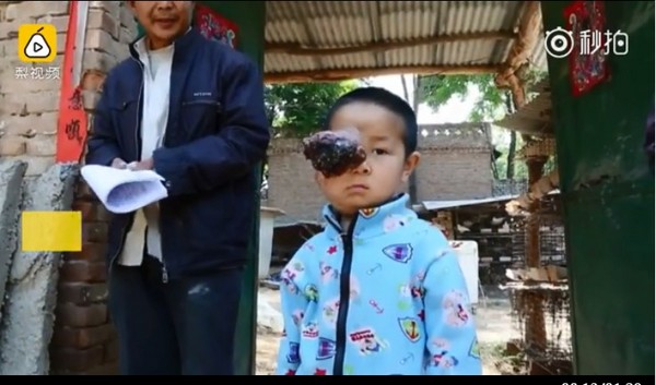 右眼「黑色巨瘤」比臉還大　神仙難救的6歲童變「奇蹟男孩」。（圖／翻攝自大陸《梨視頻》）
