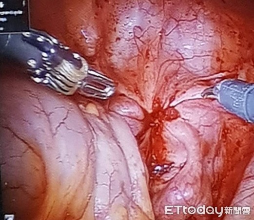 20歲女經痛到「大小便不順」 手術竟找無子宮、卵巢。(圖/劉偉民醫師提供)