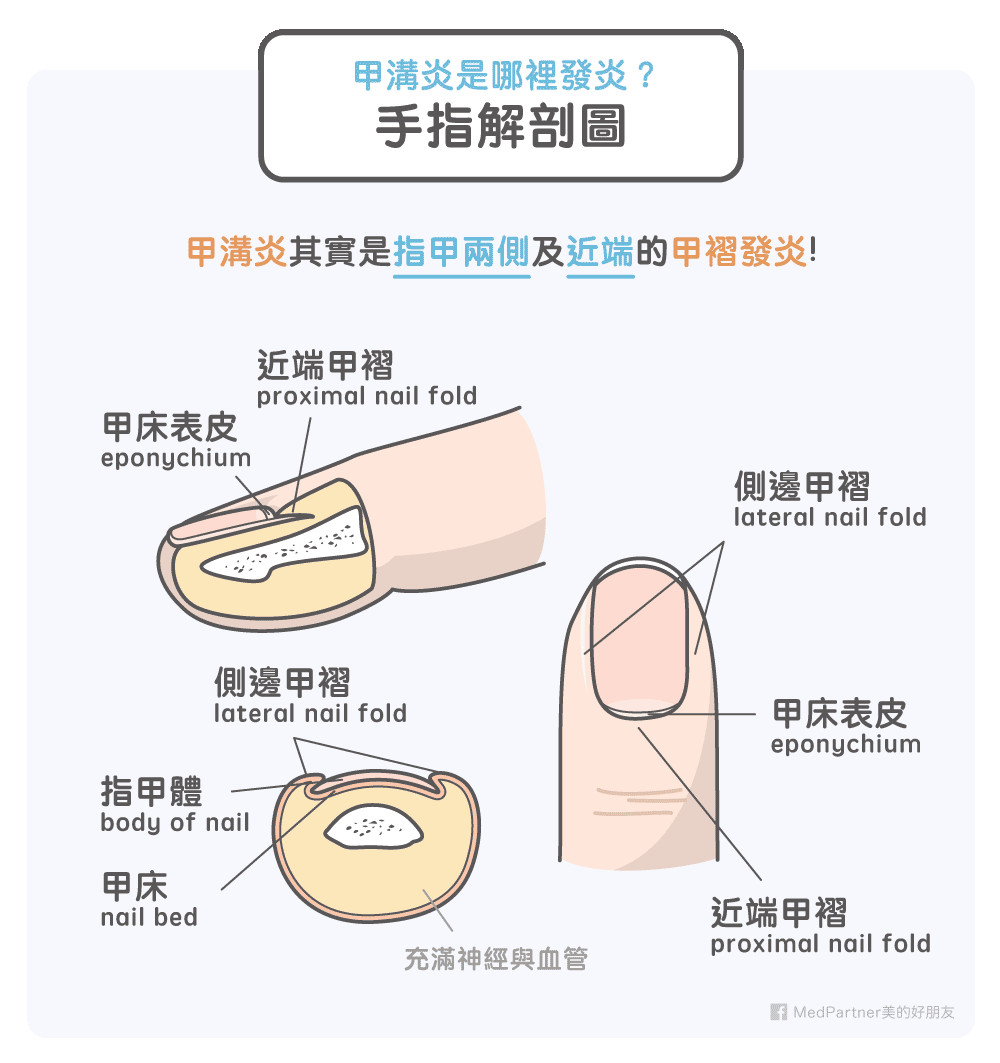 愛咬指甲、撕手指皮小心「甲溝炎」。（圖／MedPartner美的好朋友授權提供）