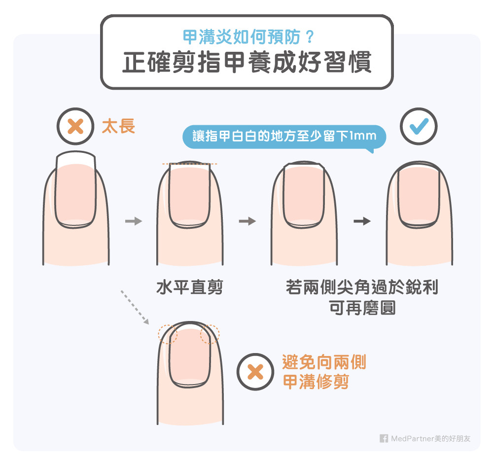 愛咬指甲、撕手指皮小心「甲溝炎」。（圖／MedPartner美的好朋友授權提供）