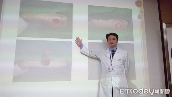 ▲褥瘡。(圖/記者嚴云岑攝)