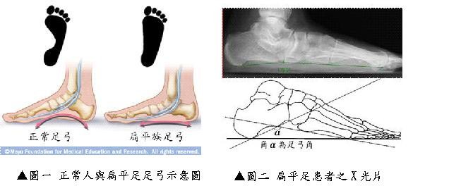 扁平足、免疫。（圖／翻攝衛福部新營醫院網站）