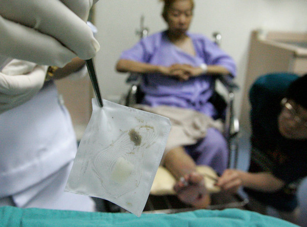 ▲泰國的一名醫師替病人進行蛆蟲療法，準備將蛆蟲放入病患體中。（圖／路透社）