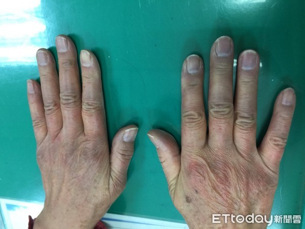 ▲雷諾氏現象。(圖/長庚醫院提供)