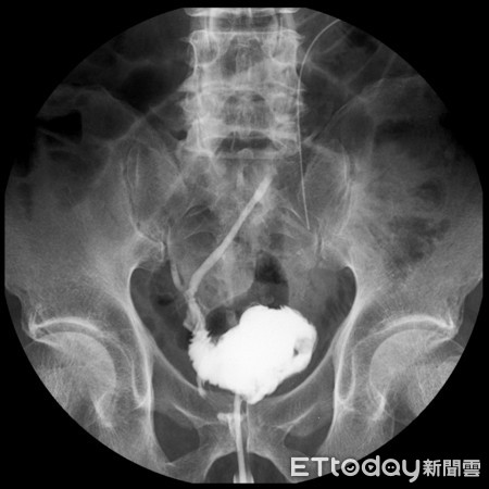 ▲血尿勿輕忽 截取小腸造膀胱。(圖/慈濟醫院提供)