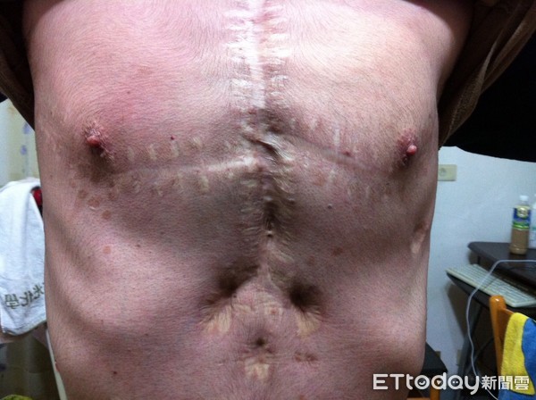 ▲換肺迎新生卻罹癌 24歲「罕病鬥士」寫出220頁勇氣之書。(圖/黃文照提供)